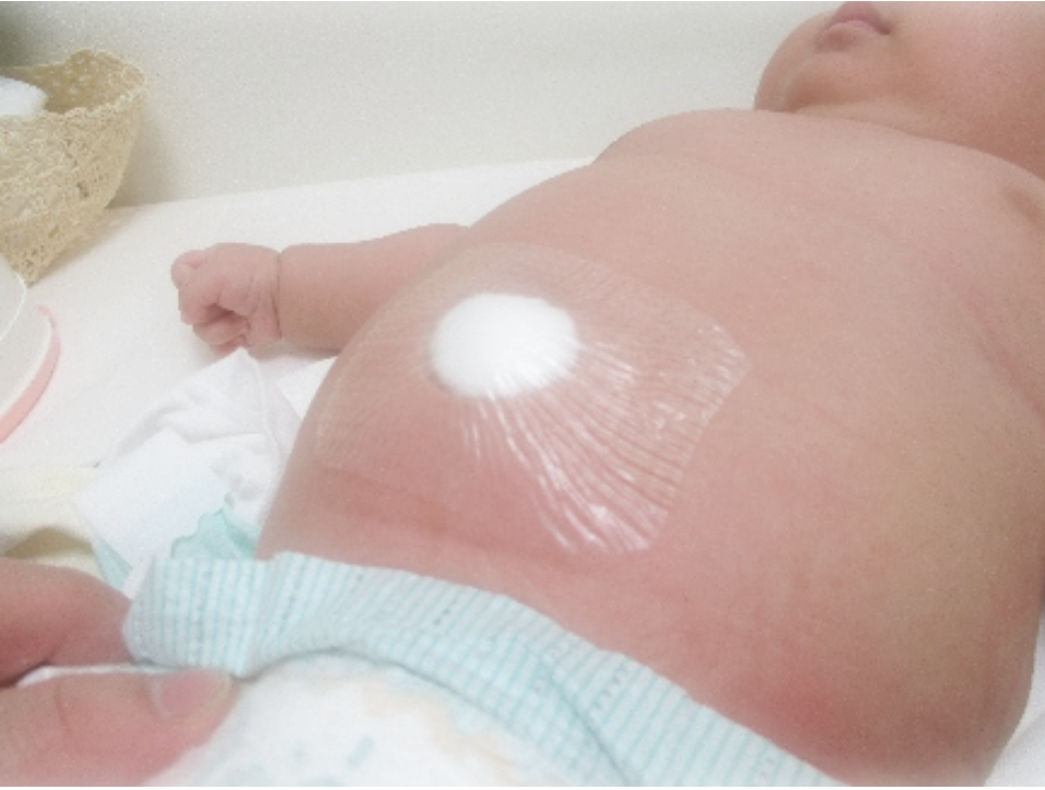 臍ヘルニアの原因は何ですか?